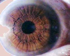 Another (possible) example of a protruding iris collarette. (Image: Luizmeira)